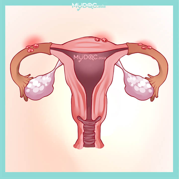 Endometrial Hyperplasia Treatment