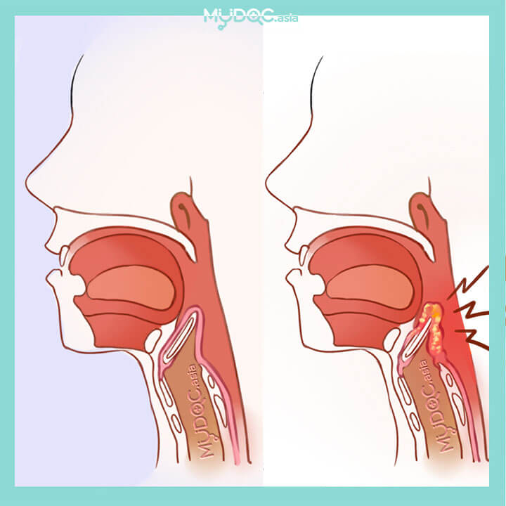 Epiglottitis Treatment