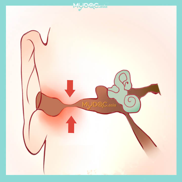Operasi Eksostosis Telinga (Surfer's Ear)
