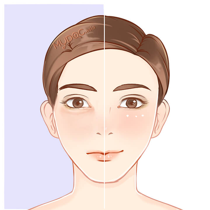 Eye Bag Revision Surgery