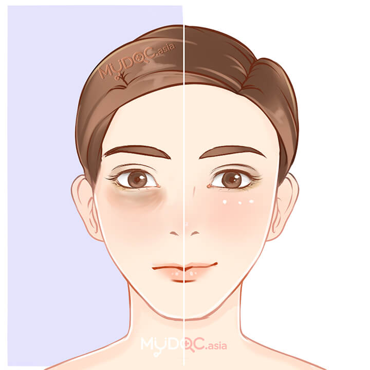 Eye Bag Removal