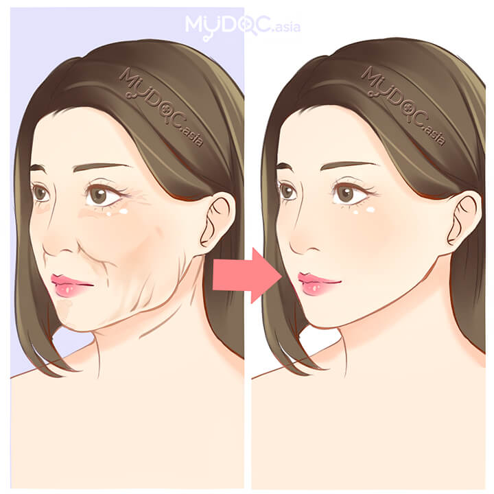 Face Rejuvenation
