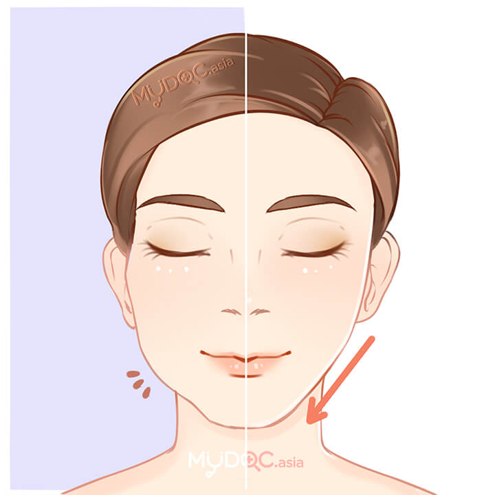 Face Reshaping