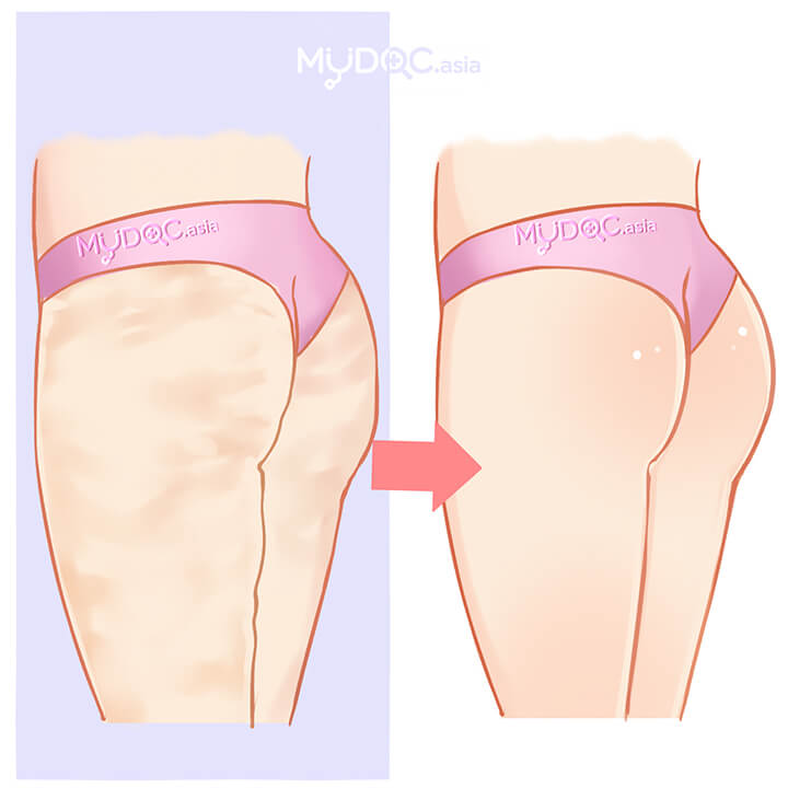 Cellulite Treatment