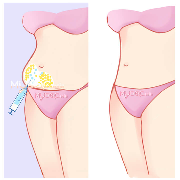 Fat Reduction Injections
