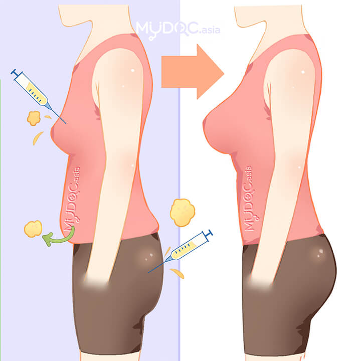 Fat Transfer (Cheek)
