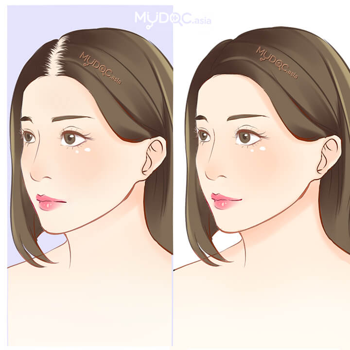 Treatment for Female Pattern Baldness