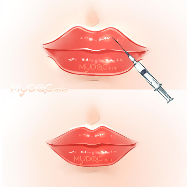 Filler Correction