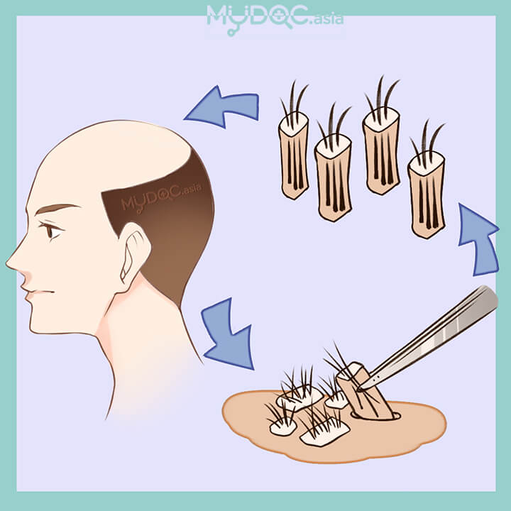 Follicular Unit Extraction (FUE)