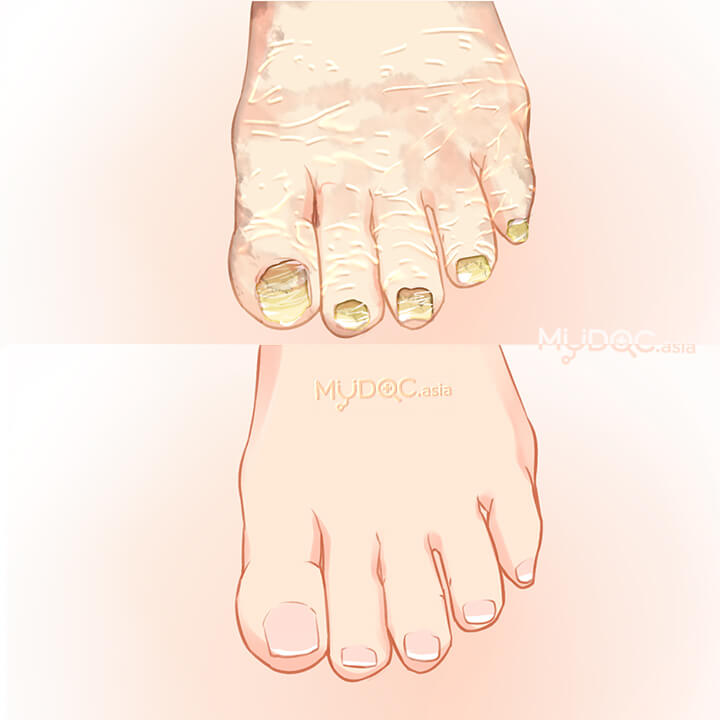 Fungal Infection Treatment