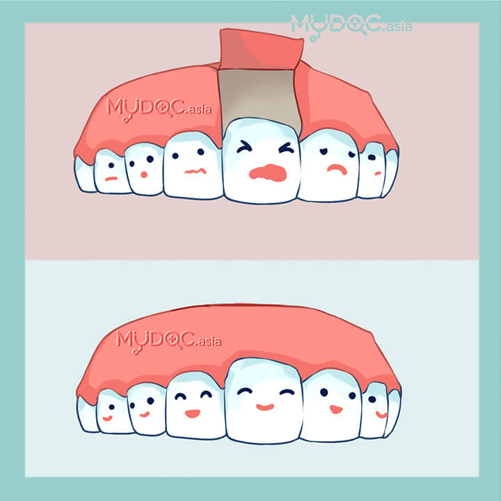 Operasi Flap Gingiva