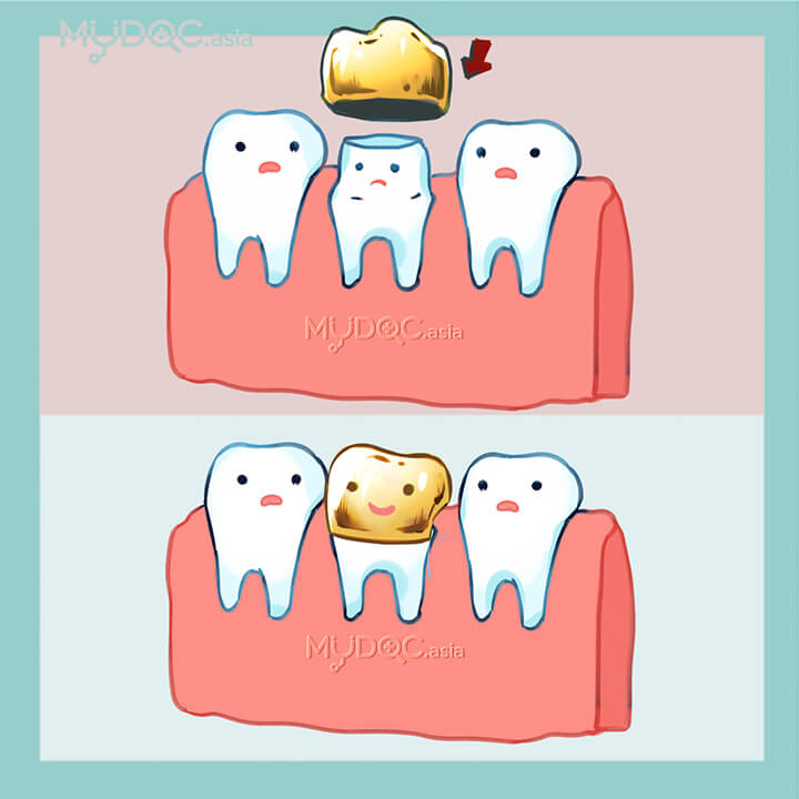 Gold Crown