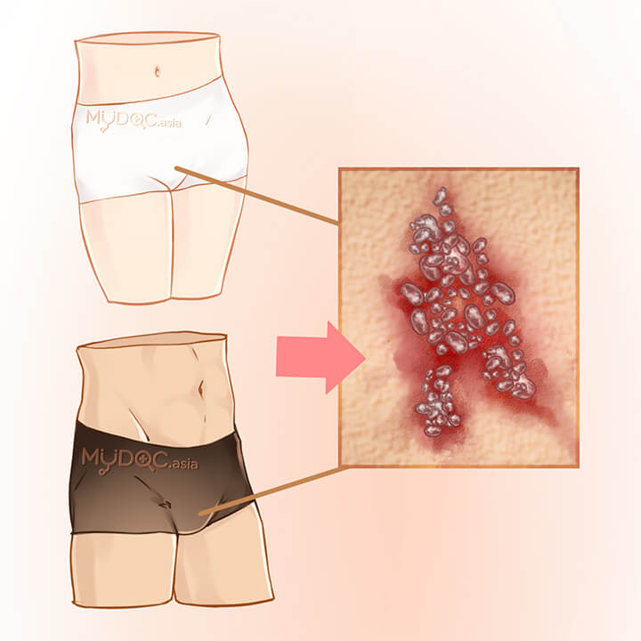 Pengobatan Gonorrhea