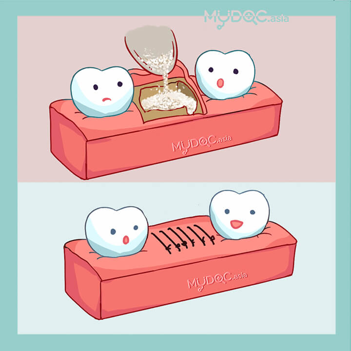 Guided Bone Regeneration (GBR)