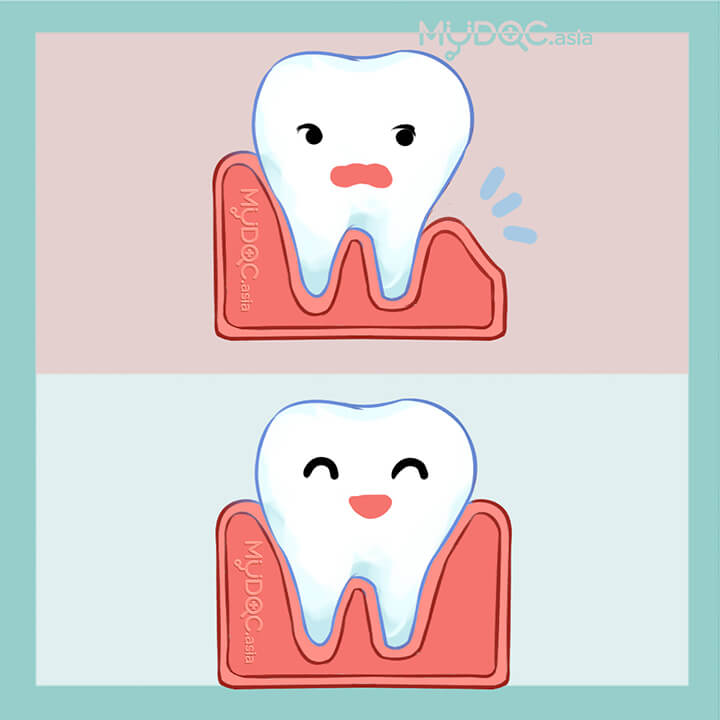 Guided Tissue Regeneration (GTR)