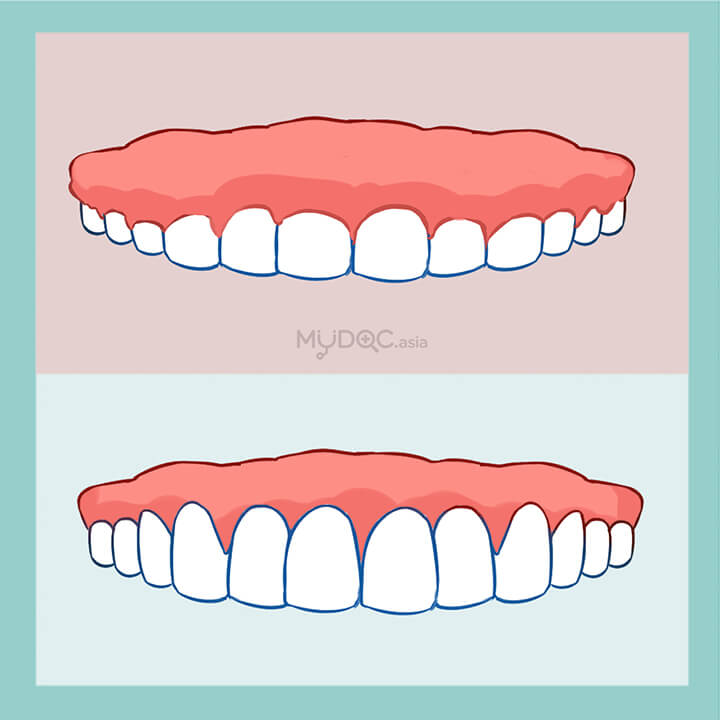 Gum Contouring and Reshaping