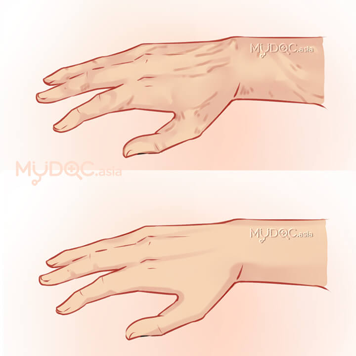 Hand Rejuvenation