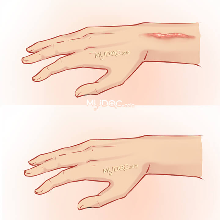 Hypertrophic Scars Treatment
