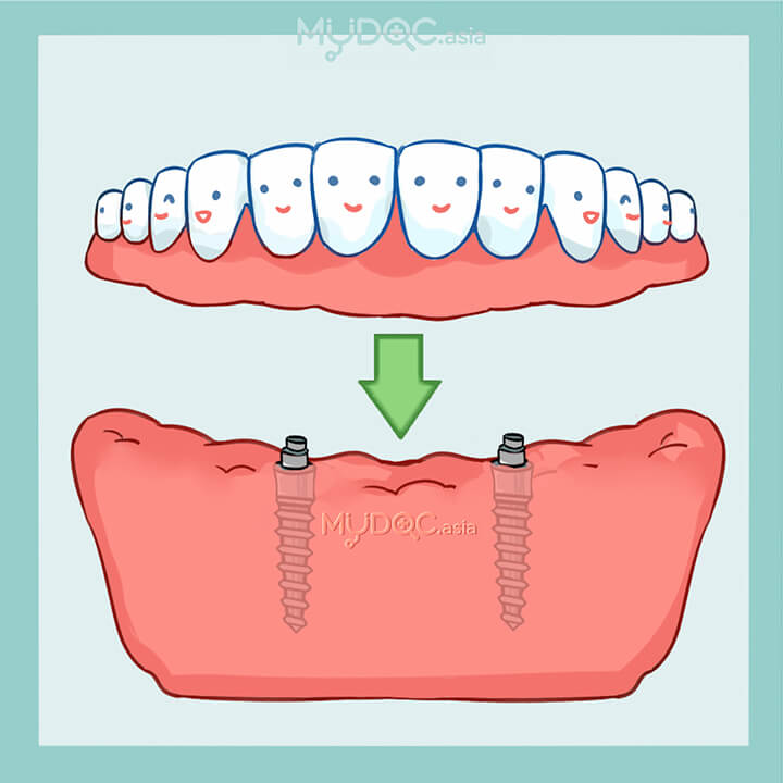 Implan Sokongan Gigi Separa Penuh (overdenture)