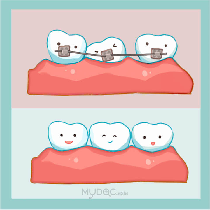 Incognito Braces