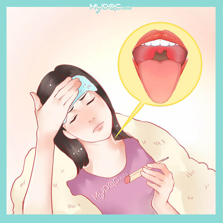 Glandular Fever (Infectious Mononucleosis) Treatment