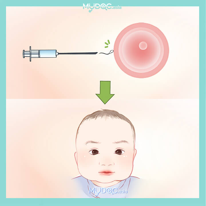 IVF - ICSI (In Vitro Fertilisation - Intracytoplasmic Sperm Injection)