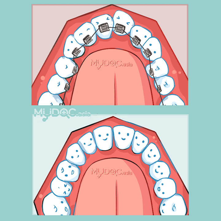 Lingual Braces (Invisible Braces)