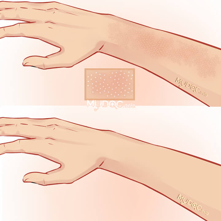 Keratosis Pilaris Treatment