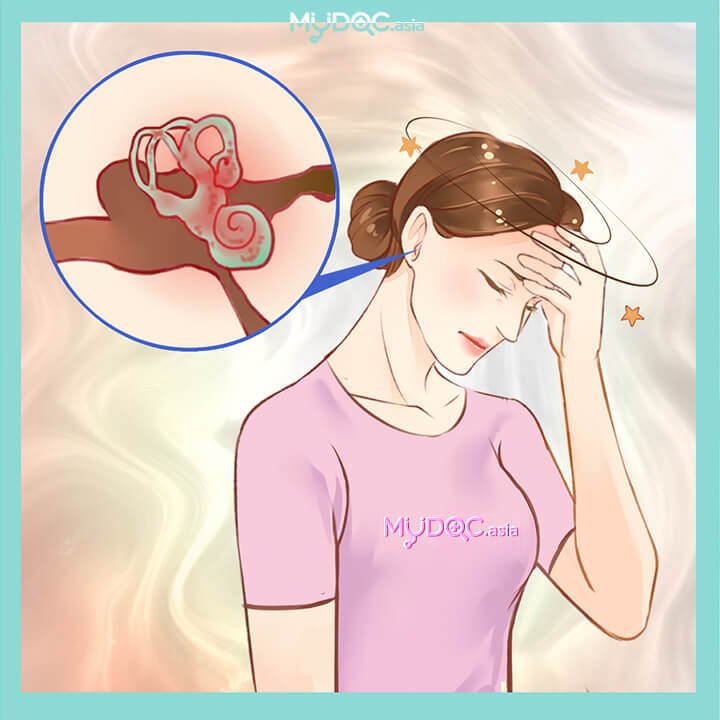 Labyrinthitis Treatment