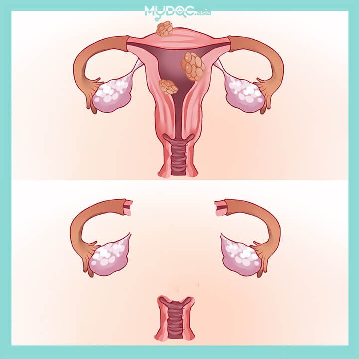 Laparascopic Hysterectomy (TLHBSO)