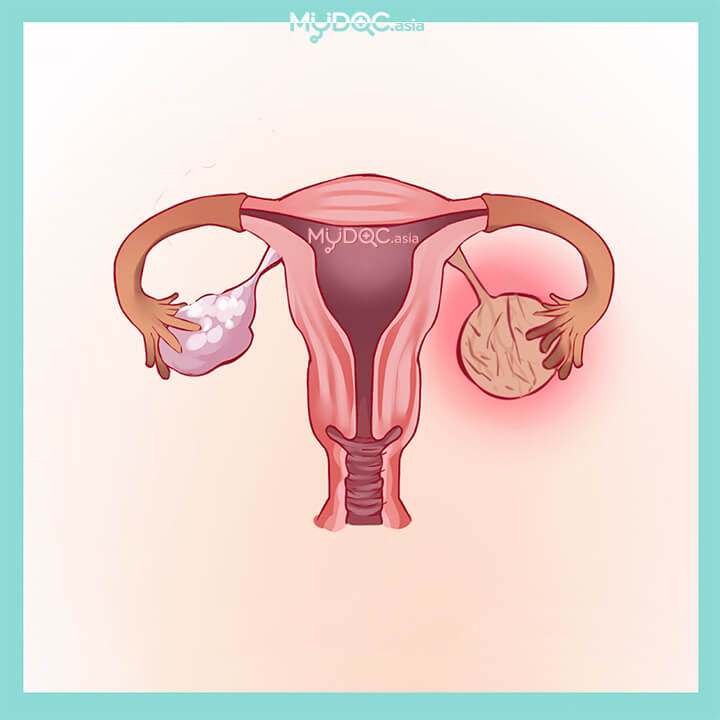 Laparoscopic Ovarian Cystectomy