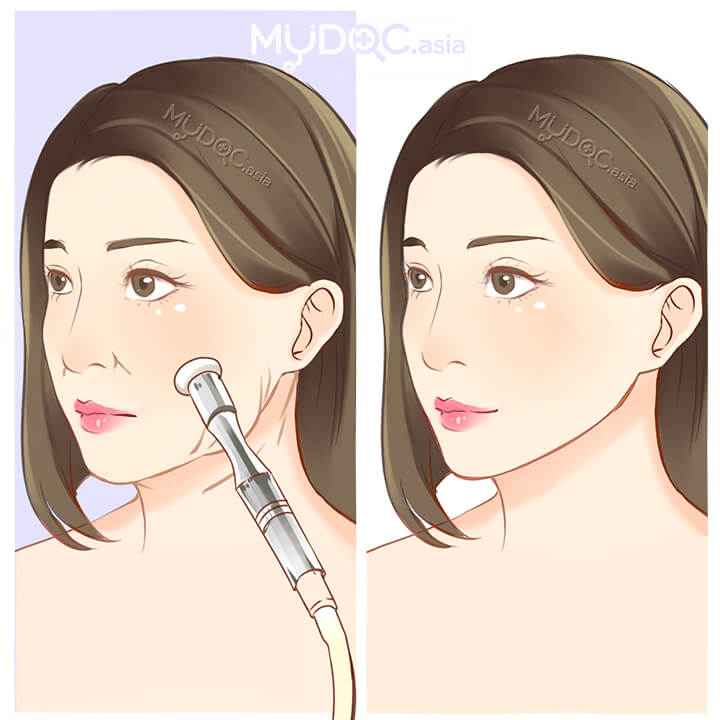 Top 5 Laser Skin Tightening In Subang Jaya Price Guide Reviews
