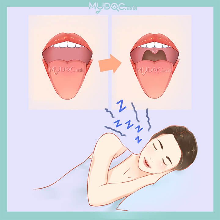 Laser Snoring Treatment