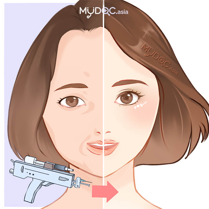 Mesotherapy