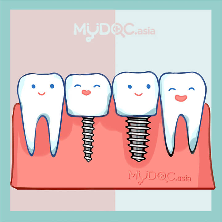 Mini Implant