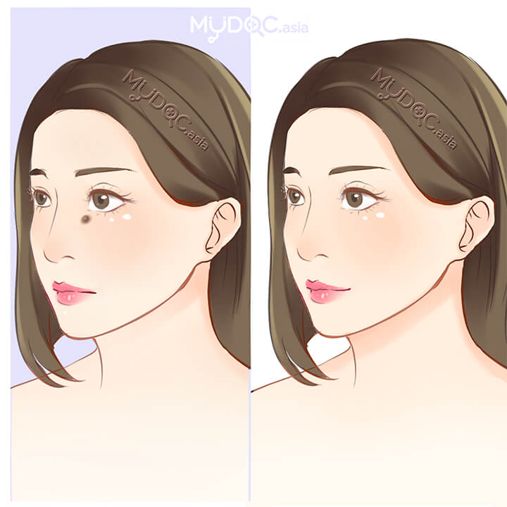 Mole Assessment