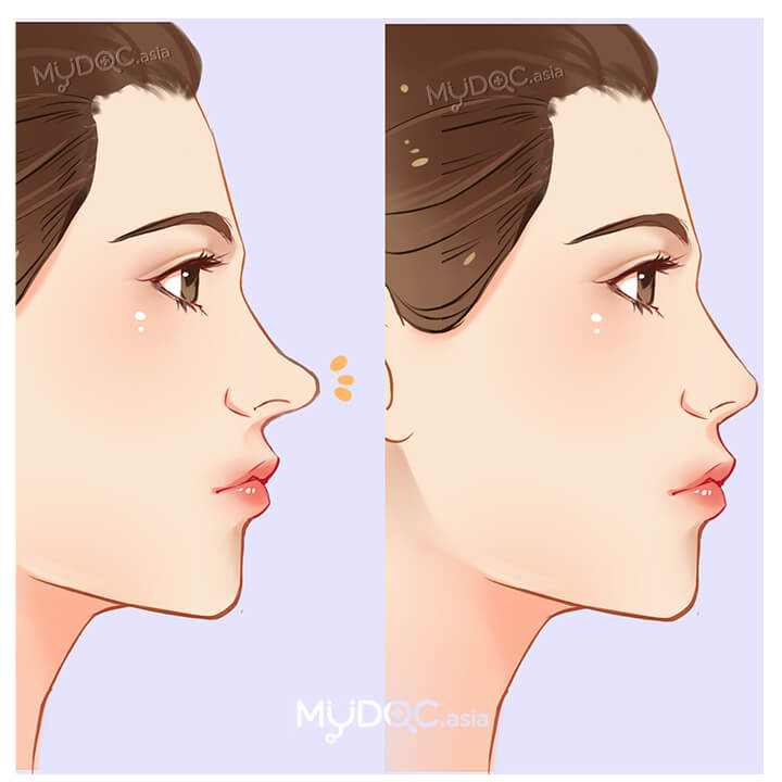 Nasal Tip Surgery