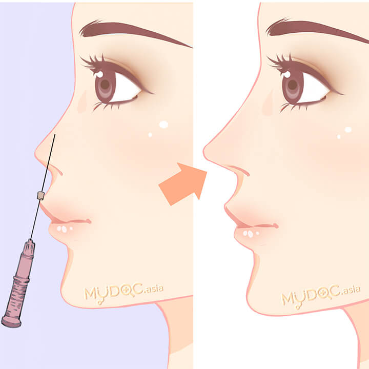 Non-Surgical Nose Job