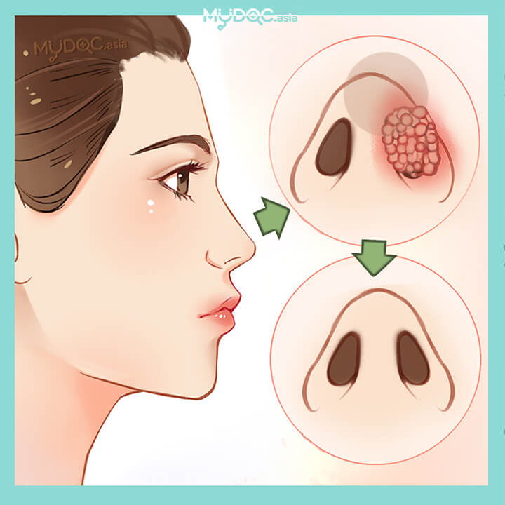 Nose Tumor Treatment