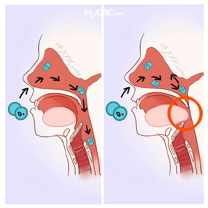 Obstructive Sleep Apnea Treatment