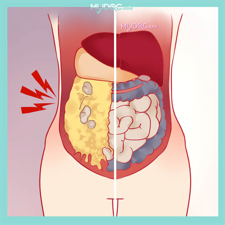 Best Laparoscopic Gynae Surgery, Fibroid Removal in Pasir Gudang, Johor