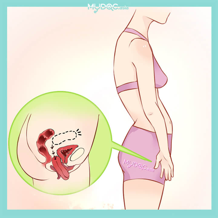 Pelvic Organ Prolapse Treatment