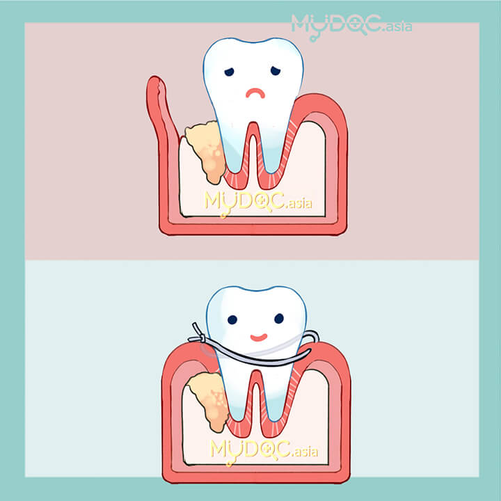 Penjanaan Semula Periodontal