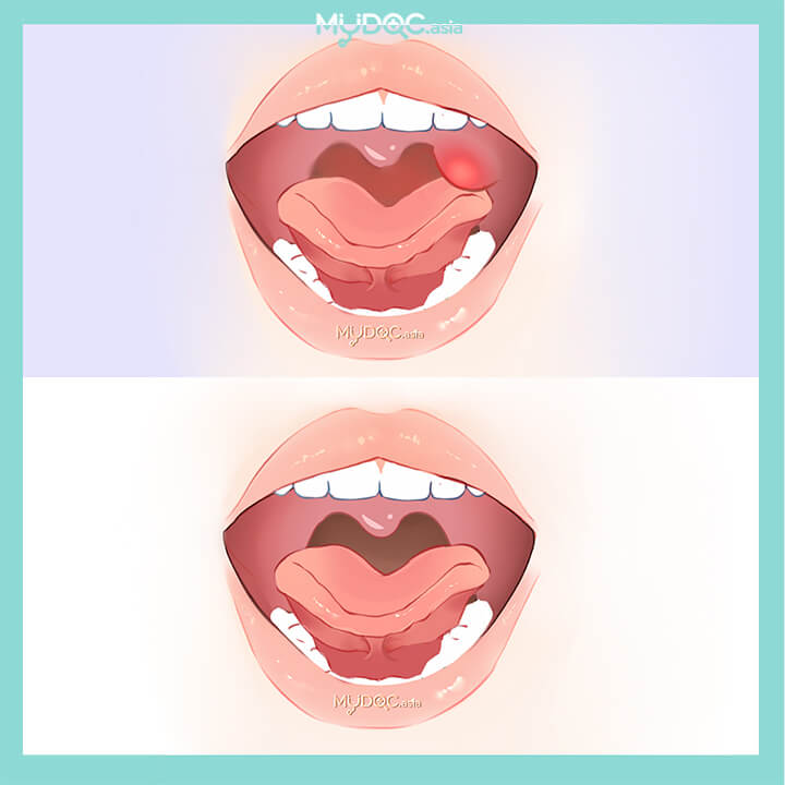 Best Quinsy (Peritonsillar Abscess) Treatment, Retropharyngeal Abscess