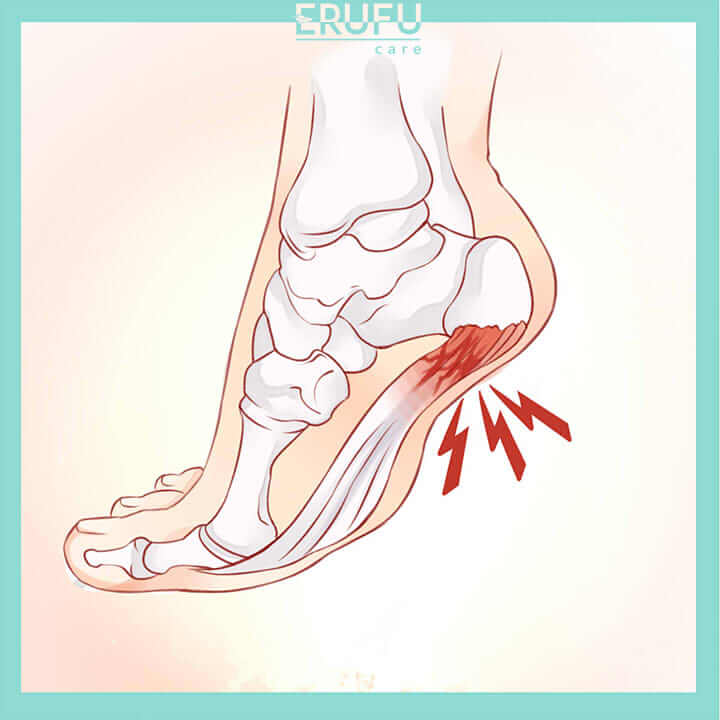 procedures icon plantar fasciitis treatment