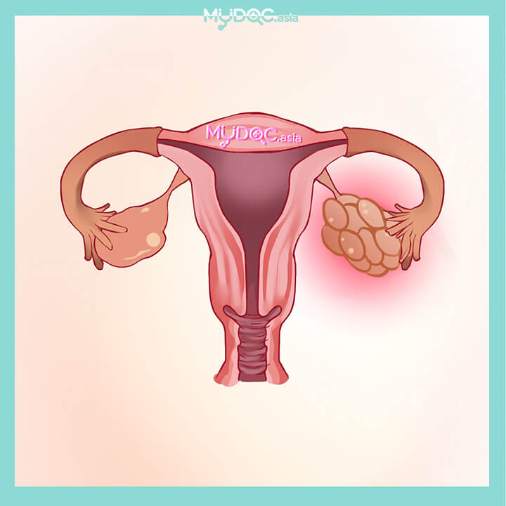 Polycystic Ovary Syndrome (PCOS) Treatment