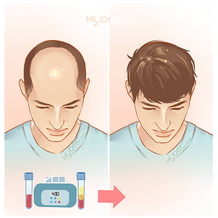 45 Best PRP Therapy for Hair Loss in Malaysia - Price Guide & Reviews