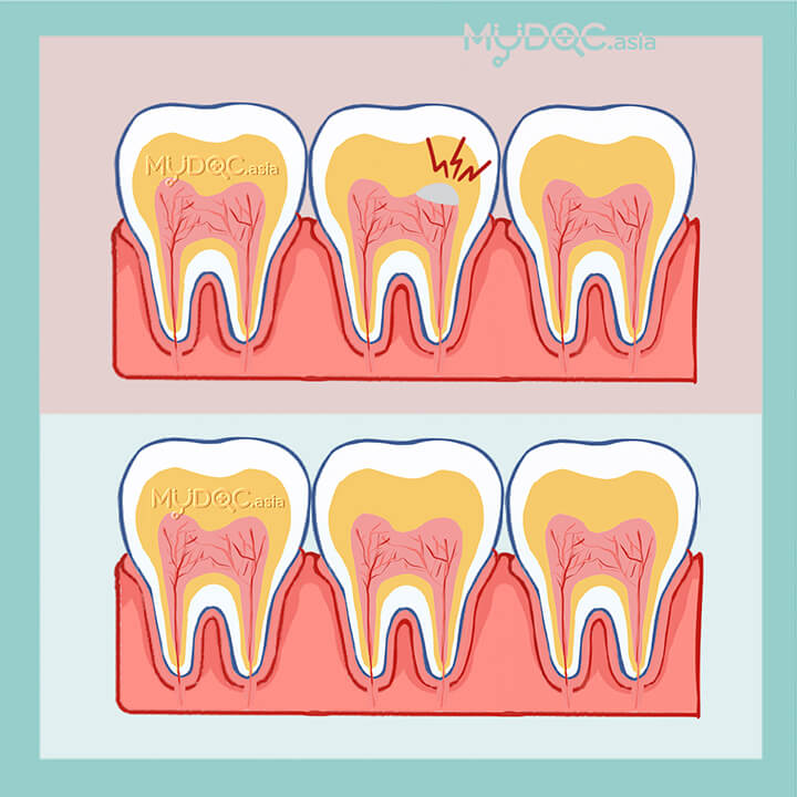 Pulpotomy