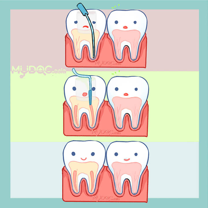 20 Best Root Canal Treatment in Kuala Lumpur - Price Guide & Reviews