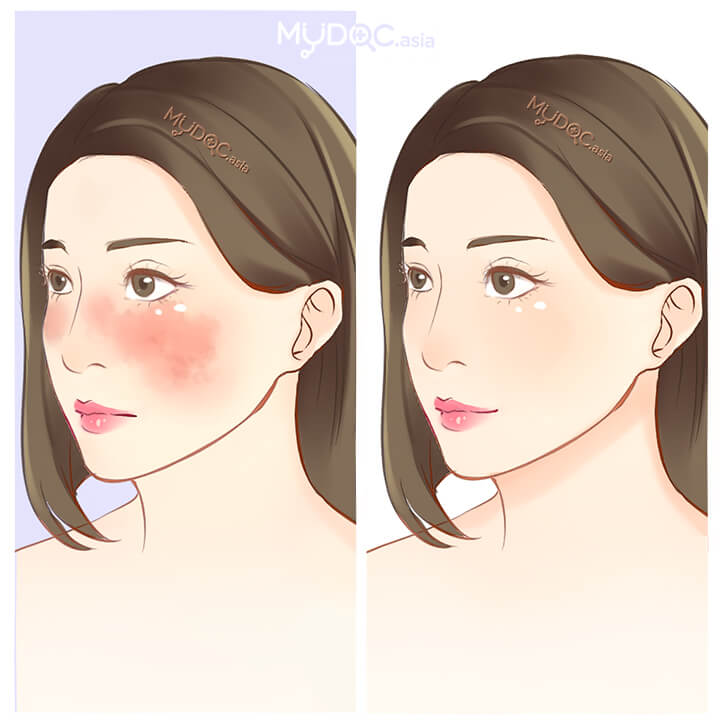 Rosacea Treatment